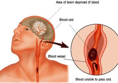 Bệnh ĐỘT QUỴ (stroke) với Thiên Khí Năng + Bấm Huyệt + Xoa Bóp Phản Xạ Học