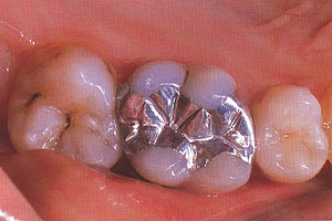 TẨY ĐỘC THỦY NGÂN trong RĂNG TRÁM CHÌ – trích “Oil Pulling Therapy (Liệu Pháp Súc dầu)” by Dr. Bruce Fife.