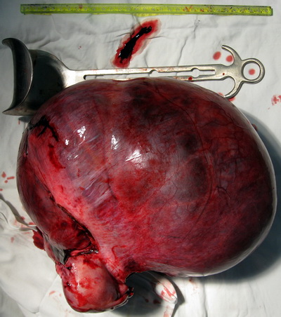 KHỐI U (TUMOR)