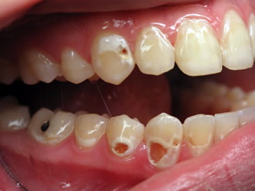 Liên quan giữa bệnh răng và bệnh toàn thân (Nhai súc dầu 3)