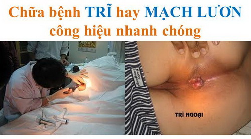 Chữa bệnh TRĨ hay MẠCH LƯƠN công hiệu nhanh chóng