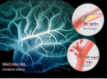Tai biến mạch máu não