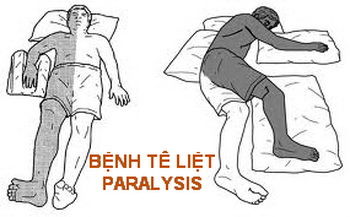 Bệnh tê liệt