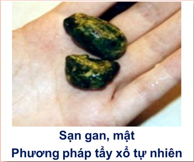 Sạn gan / mật : phương pháp tẩy xổ tự nhiên
