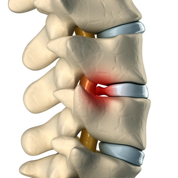Thoát vị đĩa đệm – Herniated Disk (Dr Christopher’s Herbal Legacy Newsletter March 2014)