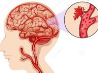 10 Tín Hiệu Cảnh Báo “Vỡ” Mạch Máu Não Không Nên Bỏ Qua